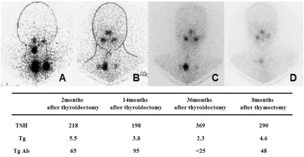 Fig.  1.  Radioiodine  scans  and  stimulated  thyroglobulin  levels.  (A)  for  2  months  after  thyroidectomy  (post-radioiodine  treatment  scan)