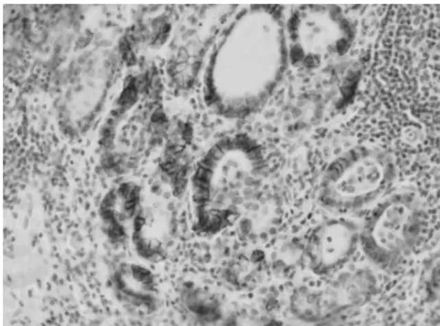 Fig.  5.  Immunohistochemistry  for  hNIS  protein  in  tissue  section  of  papillary  thyroid  carcinoma