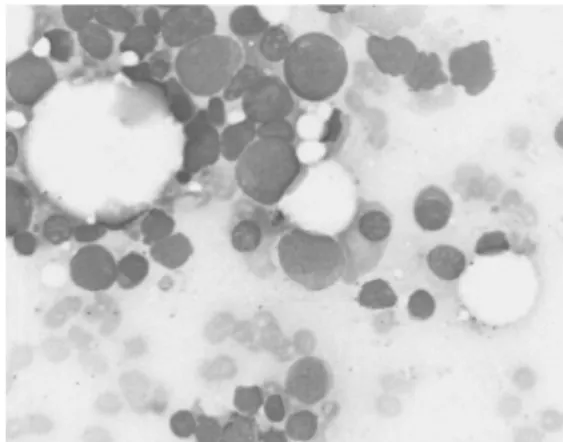Fig.  2.  Bone  marrow  aspiration  shows  hypocellularity  for  her  age  with  adequate  megakaryocyte