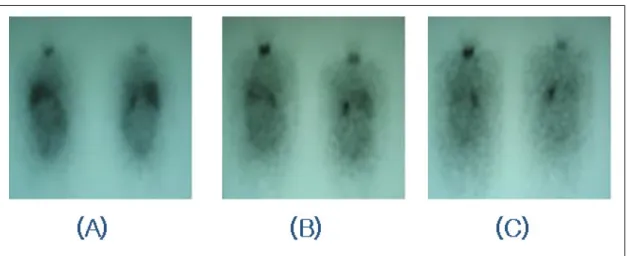 Fig.  3.  The  tumor  (3.2  ×  3  ×  2  cm  sized)  is  well  -circumscribed  and  bright  yellow  in  color