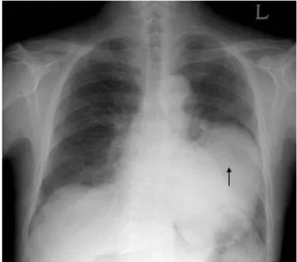 Fig.  1.  Chest  PA  shows  a  huge  mass  lesion  at  the  left  lower  lung.