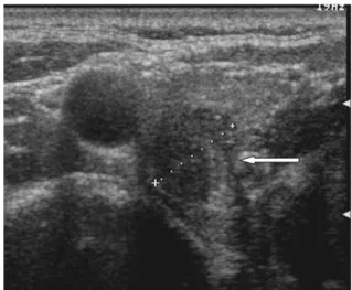 Fig.  2.  Sellar  MRI  shows  9  ×  6  mm  sized  microadenoma  in  left  portion  of  pituitary  gland.