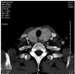 Fig.  2.  Gross  appearance  of  the  right  thyroid  gland.  Several  well-demarcated  ovoid  masses  are  noted,  ranging  from  0.4  ×  0.4  to  1.2  ×  1.0  cm
