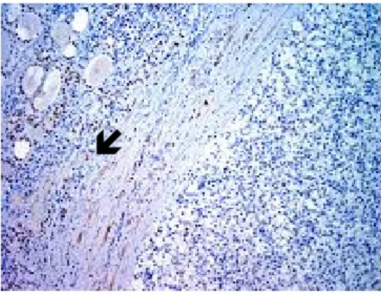 Fig.  5.  The  normal  thyroid  tissue  is  positive  for  thyroglobulin  (arrow)  while  the  metastatic  renal  cell  carcinoma  is  negative  (IHC,  ×  100).