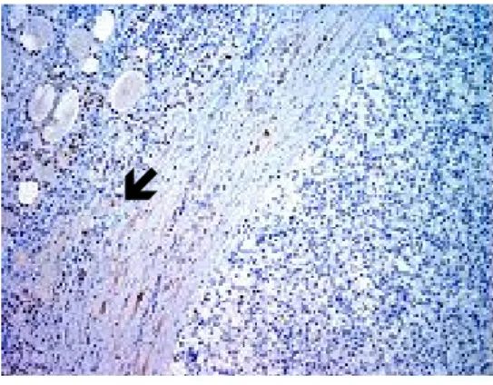 Fig.  5.  The  normal  thyroid  tissue  is  positive  for  thyroglobulin  (arrow)  while  the  metastatic  renal  cell  carcinoma  is  negative  (IHC,  ×  100).