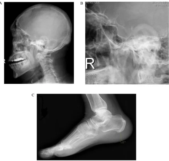 Fig.  1.  Simple  X-ray.  A,  Lateral  view  of  the  skull  shows  calvarial  thickening,  frontal  bossing  and  enlargement  of  frontal  sinus