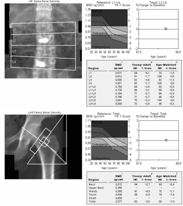 Fig.  1.  Bone  mineral  density  at  initial  diagnosis.