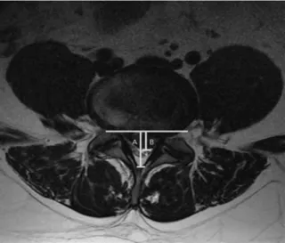 Fig.  2.  Spinal  canal  occupying  ratio=B/A×100  (%).Matsubara18),  황19)   등의  방법을  차용하여  가장  두드러지게 탈출된  추간판의  base부터  종축까지의  길이와  척추관의  종축  길이의  비,  즉  척추관  점유비을  INFINITT  PACS  G3 (ver3.0.10.2,  INFINITT,  서울,  한국)  프로그램을  이용하여 서로  다른  2인이  2회  측정한  후