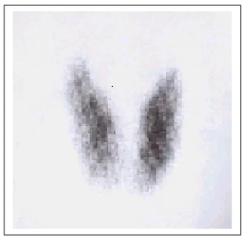 Fig.  2.  99m Tc-O 4   thyroid  scan  shows  mild  diffuse  enlargement  with  increased  uptake (case  1).