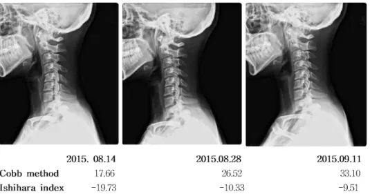 Fig.  4.  The  change  of  cervical  cur- cur-vature in C-spine lat.  view  (Case  1)