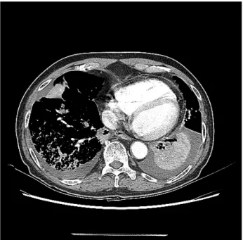 Fig.  2.  Chest  X-ray  at  May  14,  2015.  Possible  pneumonia  in  BLLs  and  both  pleural  effusion.