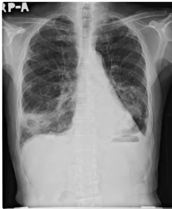 Fig.  3.  Chest  X-ray  at  May  22,  2015.  More  decreased  pneumo- pneumo-nia  in  BLLs,  still  remained  Lt