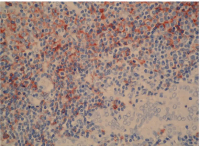 Fig.  5.  Sections  from  thyroid  gland  showing  typical  histo- histo-logic  features  of  papillary  carcinoma  (H-E,  ×100)