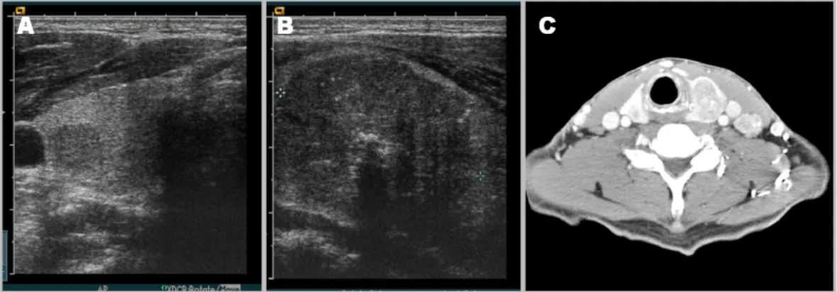 Fig.  3.  RET  proto-oncogene  mutation  in  the  patient;