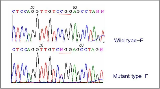 Fig.  1.  Germline  mutation  of  the  VHL  gene.  A  missence  mutation (C  to  T  transversion)  at  codon  160  on  short  arm  of  chromosome  3  was  detected,  which  leads  to  an  amino  acid  change  from  arginine  to  tryptopane