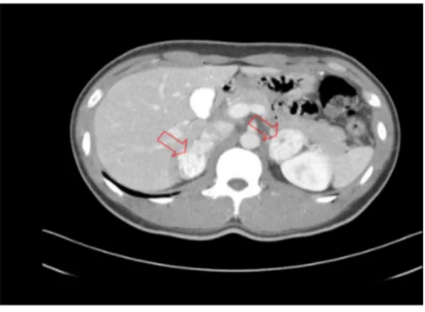 Fig.  4.  123 I  MIBG  whole  body  scan.  Small  focal  increased  uptake  is  noted  in  the  both  adrenal  gland