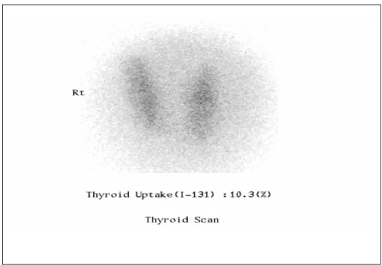 Fig.  4.  I 131   thyroid  scan  shows  mildly  enlarged  thyroid  gland  with  heterogeneous  radioiodine  uptake  (10.3%)