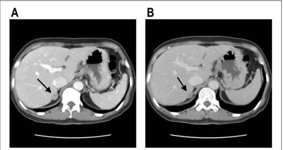 Fig.  3-A.  Gross  finding  of  adrenal  adenoma  which  is  circ- circ-ular  shaped  and  golden  yellow  colored