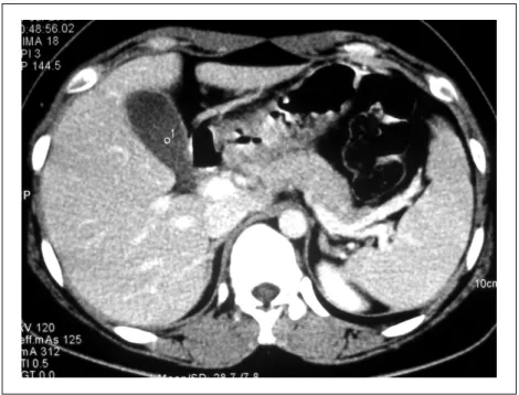 Fig.  1.  Abdominal  Computed  tomography  showed  unremarkable  liver,  gallbladder,  pan- pan-creas,  and  spleen,  without  evidence  of  biliary  dilatation.