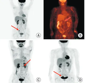 Table 2. Comparison of imaging study findings and second look  findings in patients with ovarian cancer