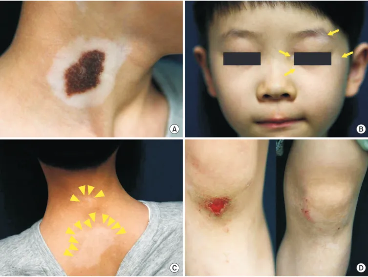 Fig. 1. Clinical images at initial visit. (A) A 6 cm-sized patch with central pigmented hairy lesion surrounded by a whitish halo phenomenon on  right neck