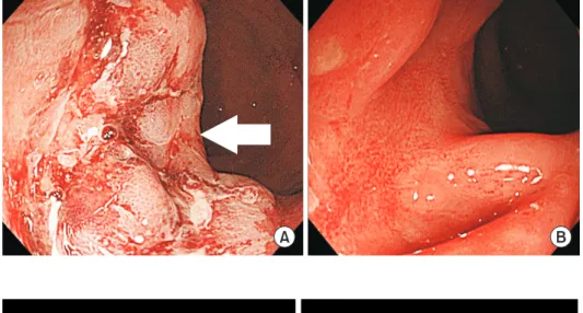 Fig. 1. Endoscopic findings. (A) Colonos- Colonos-copy shows a broad-based rectal lesion  with irregular surface and hemorrhagic  ulceration (arrow) (B) Rectal lesion is  markedly improved with remnant  ulcer-ative scarring two months later.