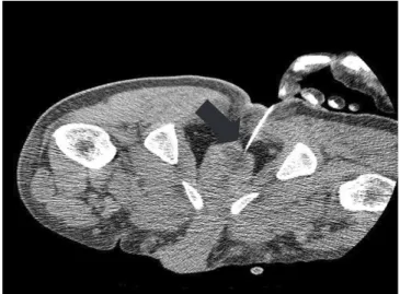 Fig. 2. Abdomen pelvic computed tomography (hospital day 7). It  shows increased size of prostate abscess that invaded into the  adja-cent bladder and rectum (black arrow).