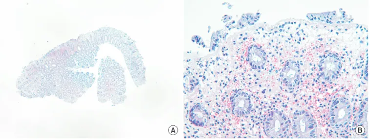 Fig. 3. Microscopic findings. Histologic findings show (A) relatively preserved cryptal architecture with diffuse ischemia and surface epithelial  loss (H&amp;E, ×40) and (B) ischemic change and minimal to mild infiltration of the inflammatory cells in the
