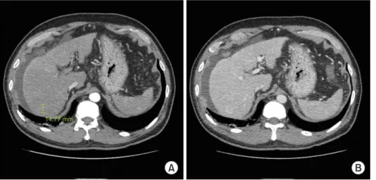 Fig. 1. CT scans a hepatocellular carci- carci-noma lesion in segment 7 is shown with  arterial enhancement (A), and delayed  wash-out of contrast (B).