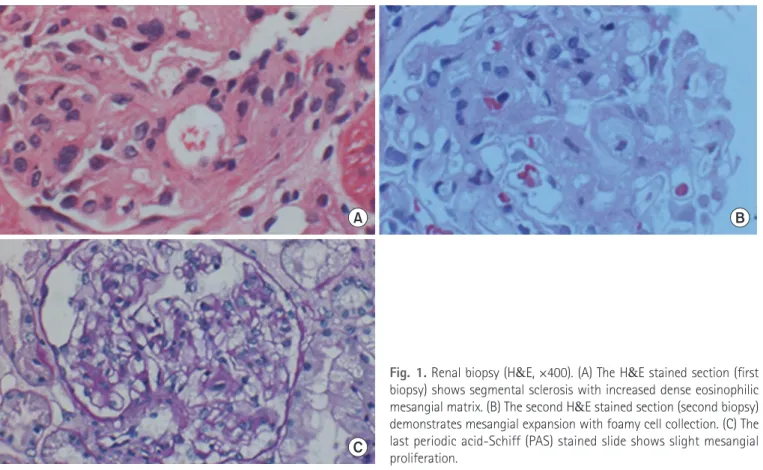 Fig. 1. Renal biopsy (H &amp;E, ×400). (A) The H&amp;E stained section (first  biopsy) shows segmental sclerosis with increased dense eosinophilic  mesangial matrix