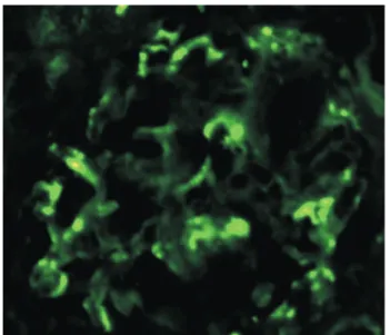 Fig. 3. Immunofluorescence (×400). The IgA immunofluorescence  test reveals diffuse mesangial reactivity with 3+ intensity.