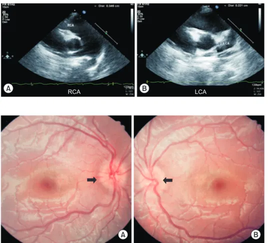 Fig. 2. Ophthalmoscopic examination  in Kawasaki disease patient. This figure  shows optic disc margin blunting of  360-degree in both eyes (A, B)