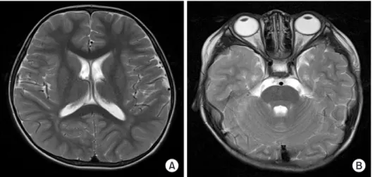 Fig. 3. Brain magnetic resonance imag- imag-ing (T2-weighted axial scan). There is no  evidence of abnormal signal lesion in the  brain