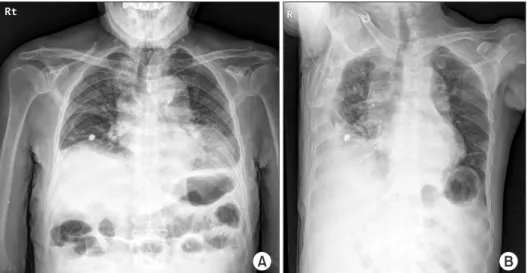 Fig. 1. Chest radiograph upon admis- admis-sion. (A) It shows diffuse ground glass  opacities, peribronchial infiltrations in  both lungs, and bilateral costophrenic  angle blunting