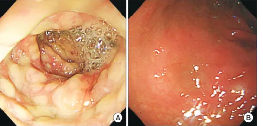 Fig. 3. Endoscopic findings. (A) Flexible  sigmoidoscopy shows multiple diffuse,  yellowish plaques on ede matous mucosa