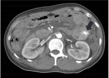 Fig. 1. Abdominal computed tomography finding. It shows extrava- extrava-sation of contrast agent with 1.5 cm sized filling detect (black arrow)