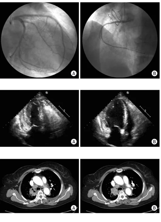Fig. 5. Chest computed tomography  image obtained on admission. Chest  computed tomography shows an  approxi-mately 4.4-cm long, enhancing mass-like  consolidation in the right upper lobe of  the lung at serial axial image (A) and (B).