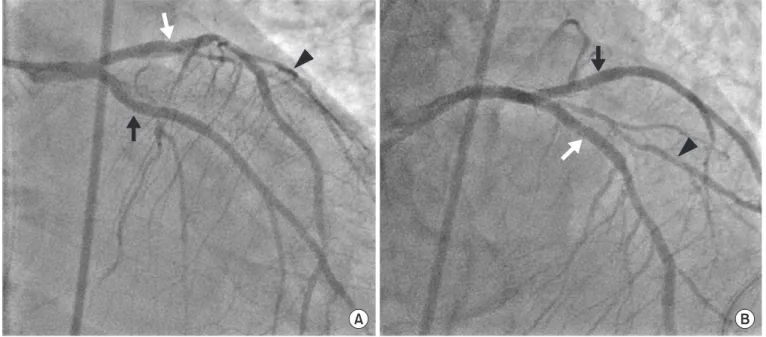 Fig. 4. Coronary angiogram after the intervention. (A) Caudal view of left system angiogram