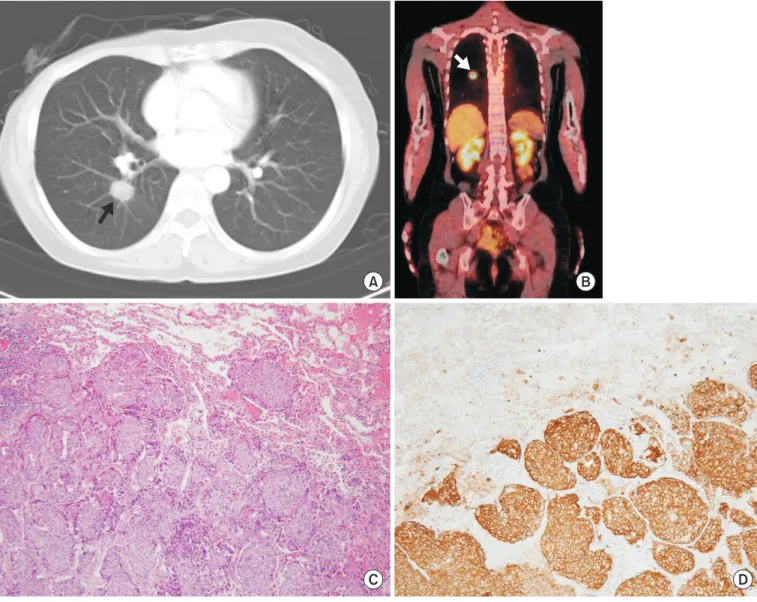 Fig. 2. Radiologic and microscopic findings of pulmonary nodule. (A) A chest computed tomography scan shows a single nodule in the lower  lobe of the right lung (black arrow)