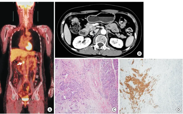 Fig. 3. Radiologic and microscopic findings of pancreatic head lesion. (A) An 18F-fluorodeoxyglucose positron emission tomography computed  tomography scan shows a hypermetabolic lesion (standardized uptake value, 7.7) in the pancreatic head
