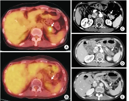 Fig. 4. Radiologic findings of pancreatic  tail lesion with complete response. The  pancreatic tail mass has been initially  shown as a hypermetabolic lesion  (stan-dardized uptake value, 3.3) on an  18F-fluorodeoxyglucose positron emission  tomography com