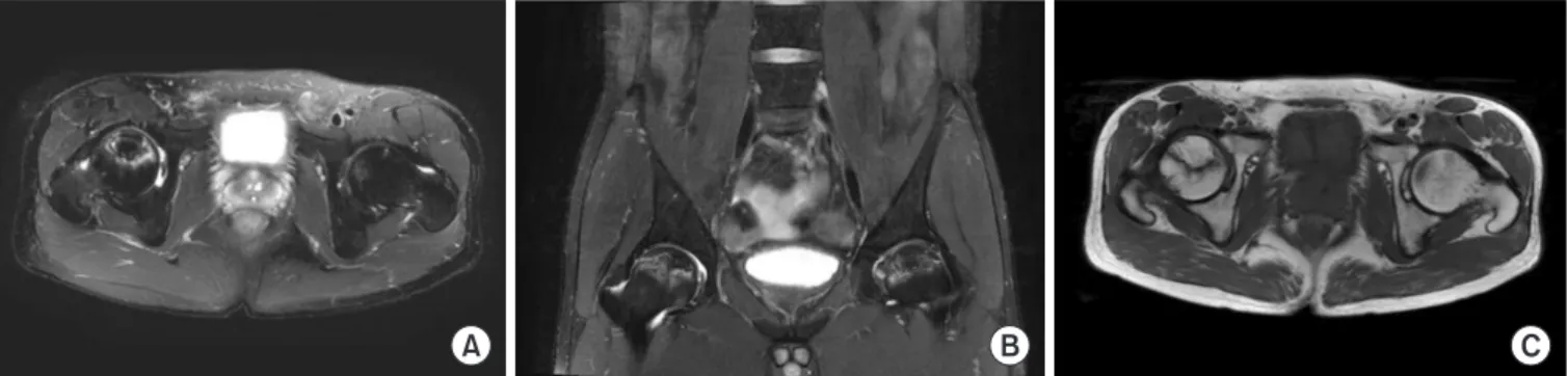 Fig. 2. MR images. They show serpiginous high signal intensity areas at both femoral heads are seen on T2 fat saturation images, transverse (A)  and coronal (B) section, and on the low sacro-illiac line on T1-weighted image (C) without significant flatteni