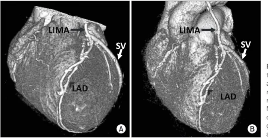 Fig. 3. Preoperative 3-dimentional mul- mul-tidetector computed tomography (MDCT)  angiography showing the left internal  mammary artery (LIMA) and the  saphe-nous vein grafts (A)