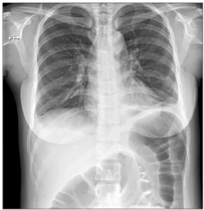 Fig. 2. Abdominal and pelvic computed  tomography, cross-sectional (A) and  coro-nal (B) view