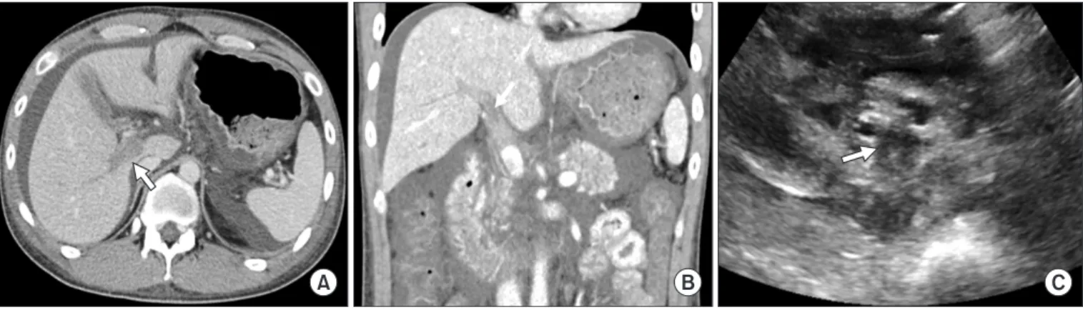 Fig. 2. Follow-up abdominal ultrasonography eight weeks after the  onset of portal vein thrombosis