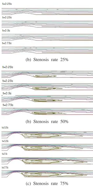 Fig. 7 Streamlines in the flow fields at four  different times in the velocity profile with  various stenosis 75%  협착률과  평균  레이놀드  수가  Re=200인  경우  Fig