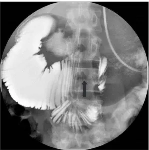 Fig. 4. Follow-up upper endoscopy after 2 months showed complete recovery from the gastric emphysema (A, B) and a mildly constricted third  segment of the duodenum by extrinsic superior mesenteric artery compression (C)