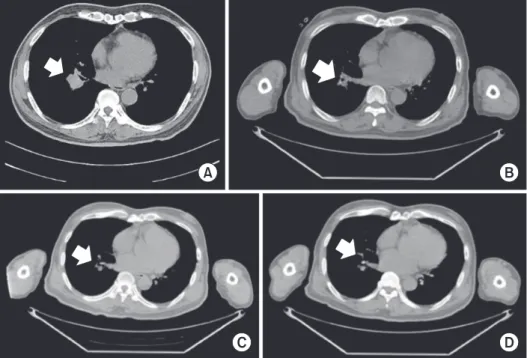 Fig. 1. Positron emission tomography  at the time of initial diagnosis (A), after 3  cycles of treatment (B), after 6 cycles of  treatment (C), and 6 weaks after the  treat-ment completion (D).