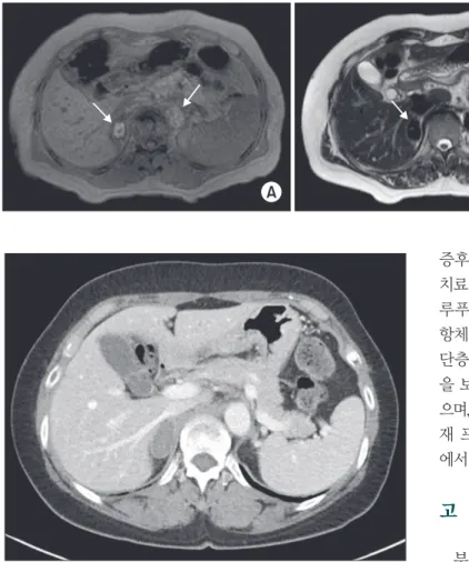 Fig. 4. Follow-up contrast-enhanced abdominal computed tomogra- tomogra-phy (CT) after 2 weeks