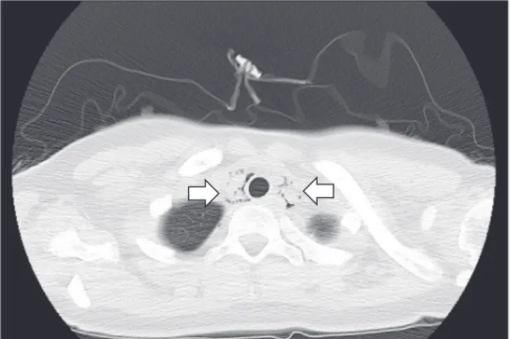 Fig. 2. Chest computed tomography (CT) findings on admission. An  axial CT image shows diffuse pneumomediastinum around neck,  esophagus, aorta and trachea (arrow).